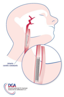 Stent (Micromesh)