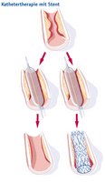 Stenting